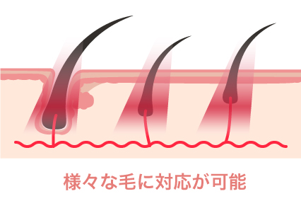 3つの波長で細い毛にも対応